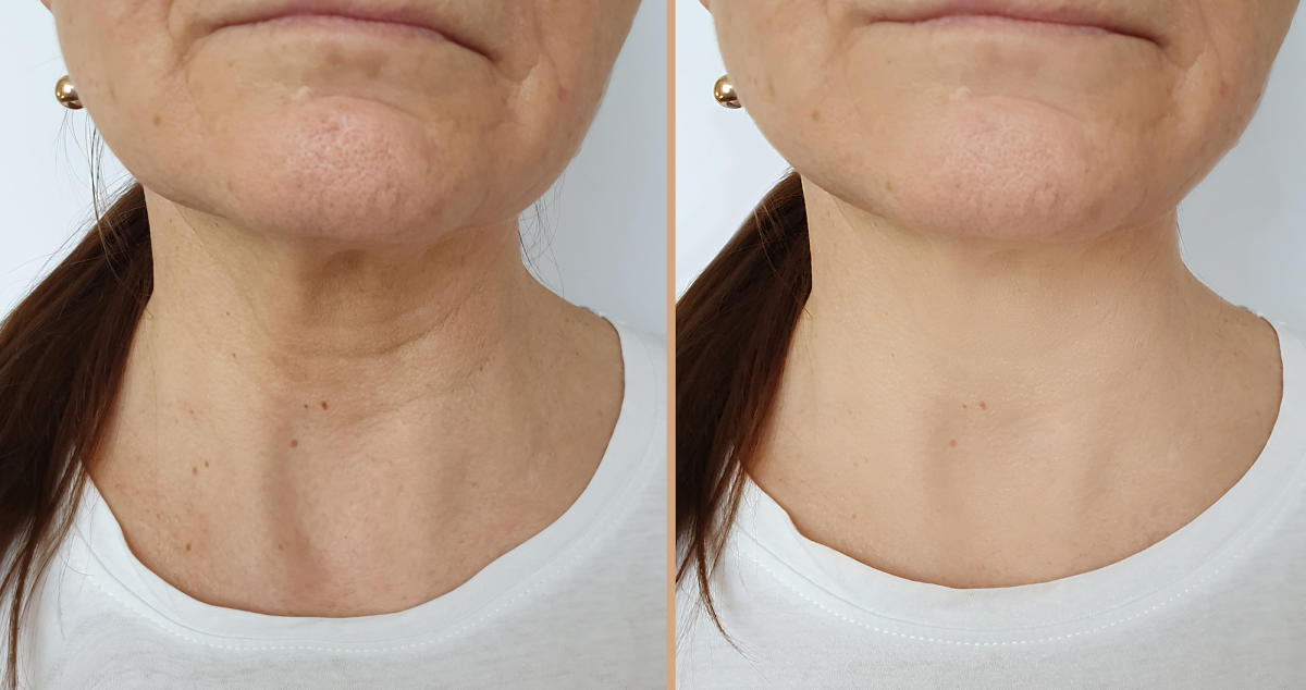 tend skin review before and after on neck｜TikTok Search