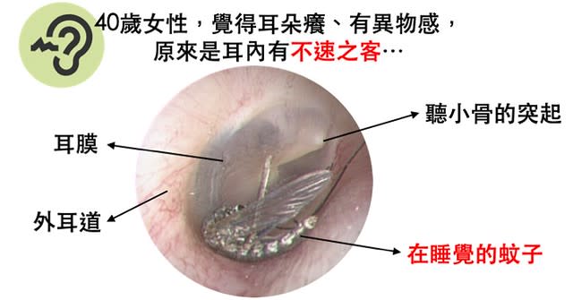 40歲女性，覺得耳朵有異物感、會癢而來求診