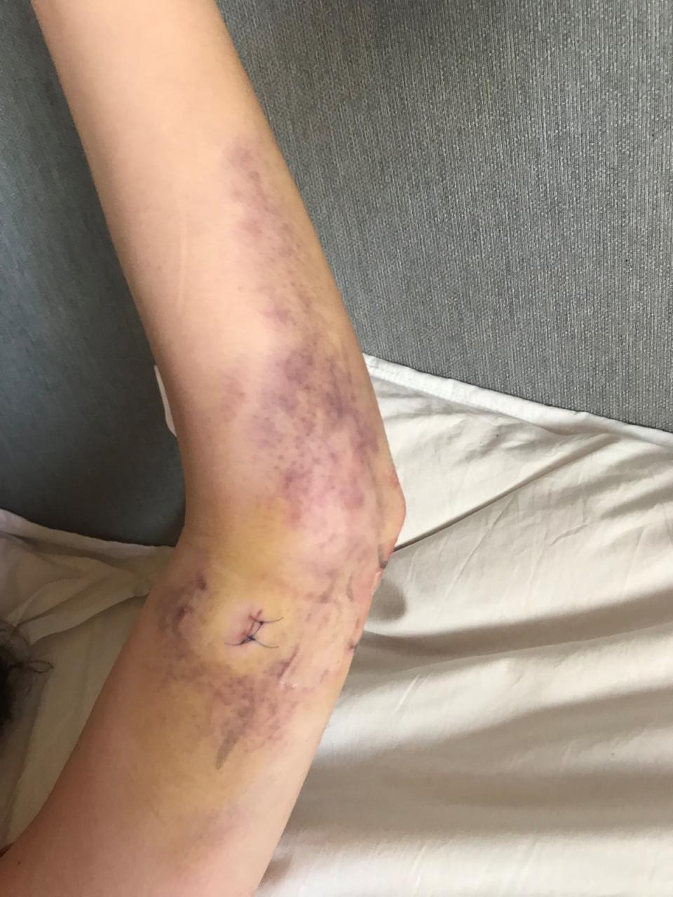 Ms Meron’s elbow after an operation (Supplied)