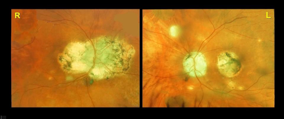 Imágenes de un ojo afectado por histoplasmosis. <a href="https://www.shutterstock.com/es/image-illustration/illustrates-inside-actual-eye-when-person-2056545854" rel="nofollow noopener" target="_blank" data-ylk="slk:Shutterstock / Richard L. Bowman;elm:context_link;itc:0;sec:content-canvas" class="link ">Shutterstock / Richard L. Bowman</a>