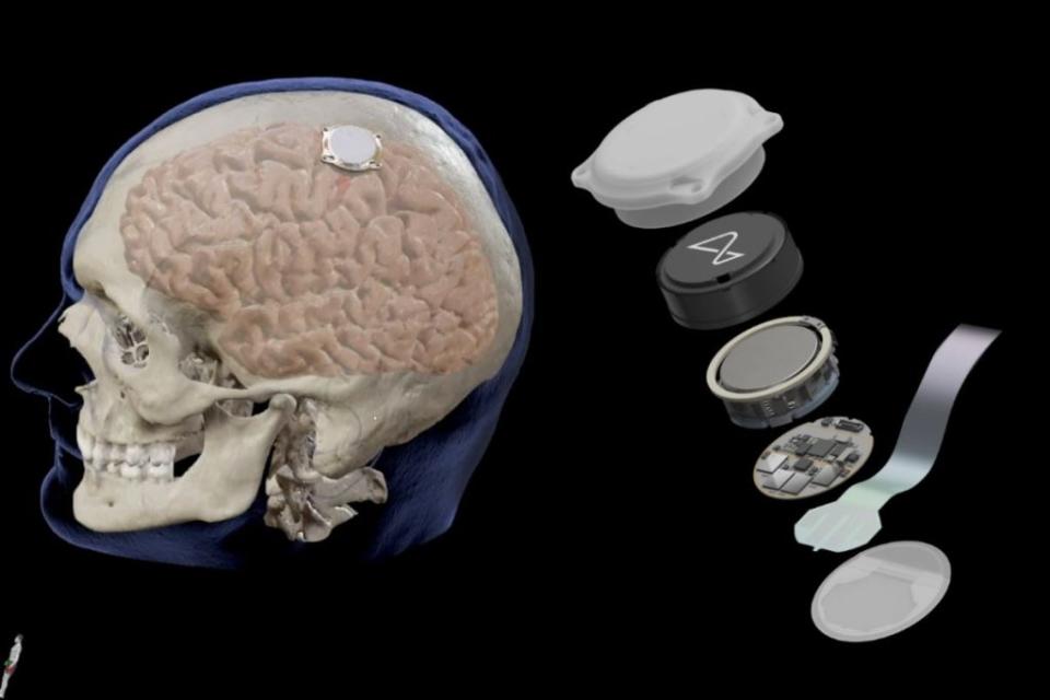 Imagen del chip cerebral implantado por Neuralink. Foto de Animal político. 