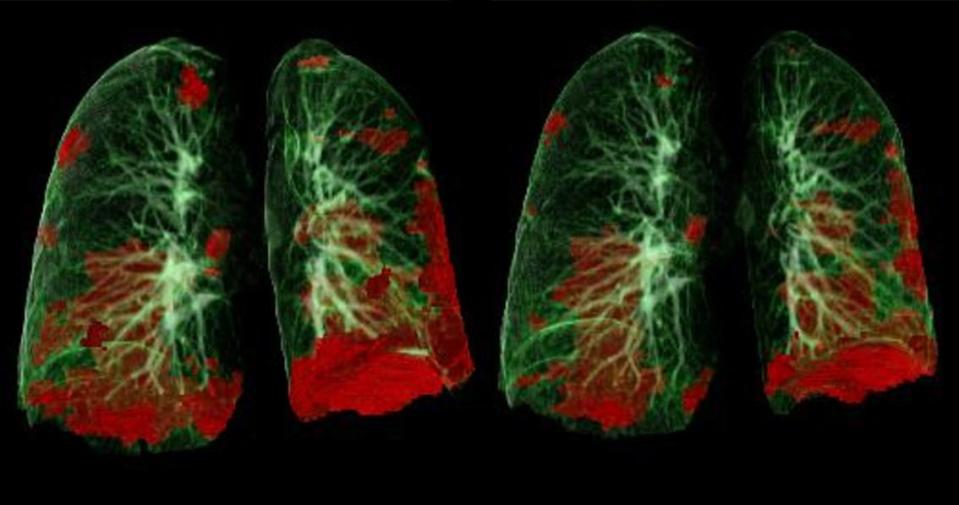 coronavirus lungs 