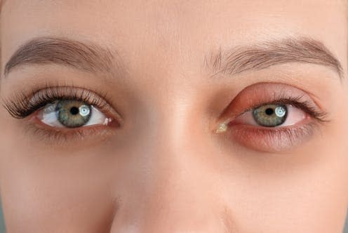   <span class="attribution"><a class="link " href="https://www.shutterstock.com/image-photo/woman-inflamed-eye-suffering-conjunctivitis-closeup-2308094537" rel="nofollow noopener" target="_blank" data-ylk="slk:New Africa/Shutterstock;elm:context_link;itc:0;sec:content-canvas">New Africa/Shutterstock</a></span>