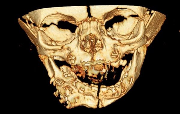 女嬰臉部的電腦掃瞄三維重建。（圖/翻攝自《英國醫學期刊》）