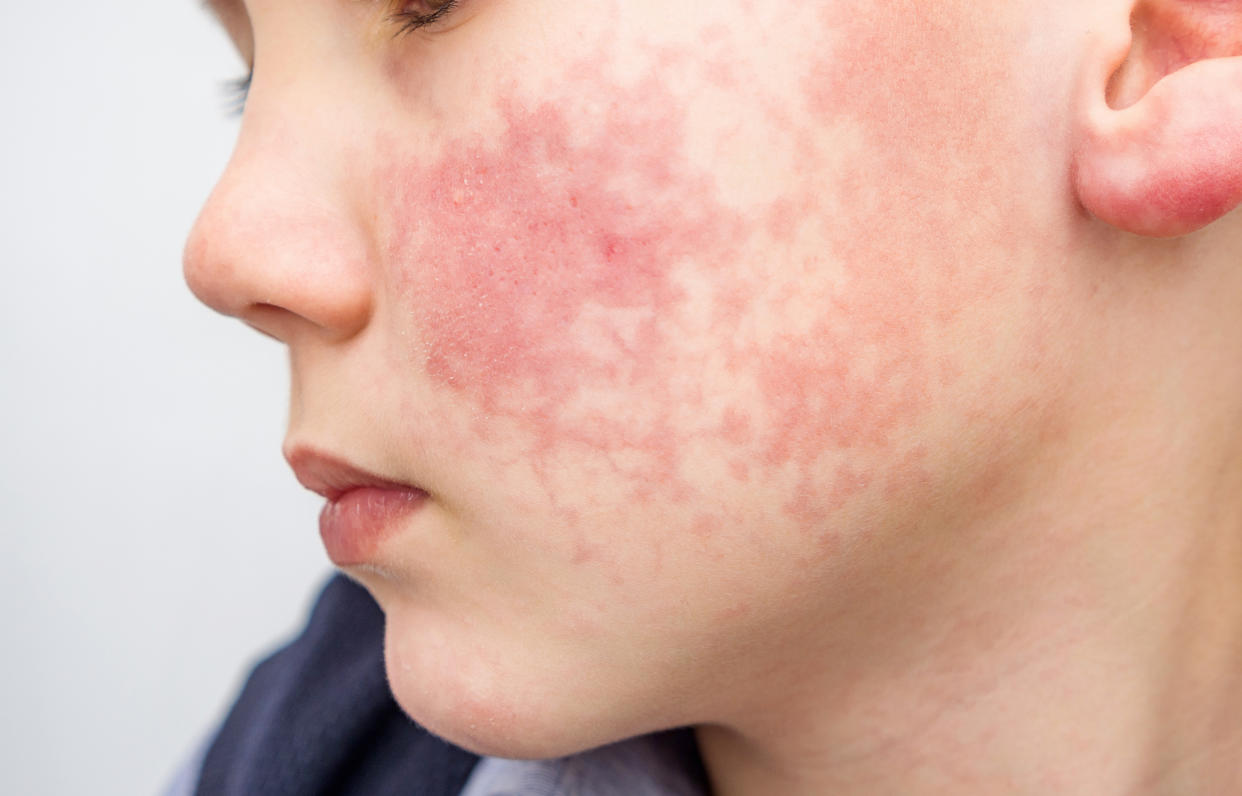 Boy with rosy red cheeks- diathesis or allergy symptoms. Redness and peeling of the skin on the face.