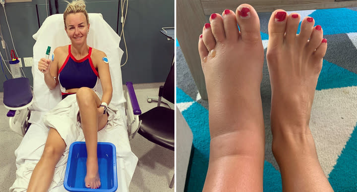 Whitney Jones pictured with an enlarged foot from the venom. 