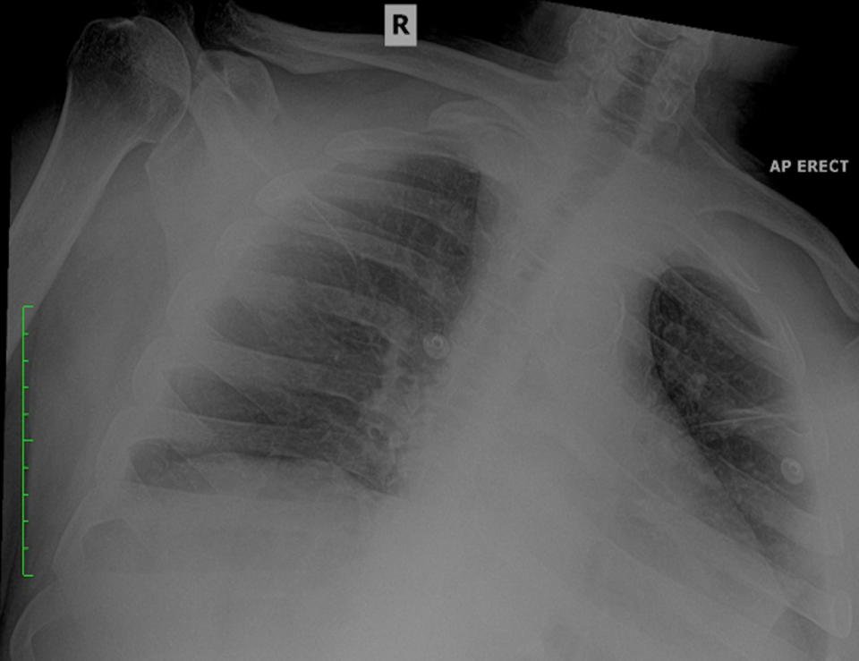 A chest radiograph of a 73-year-old man with aspiration pneumonia.