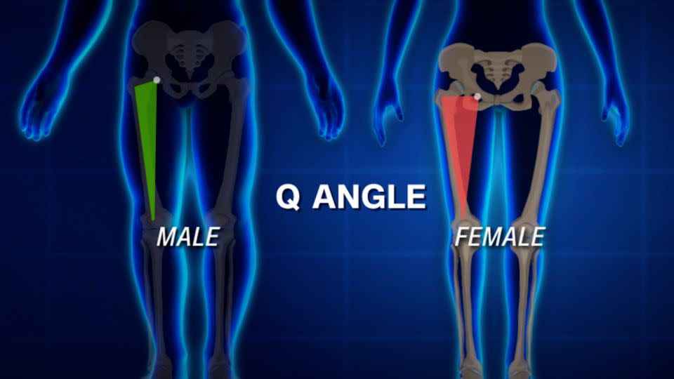 The Q angle is the ratio of hip width to femur length; women have larger Q angles, which can put more stress on the ACL. - CNN
