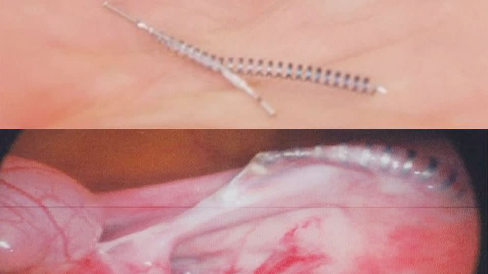 Over 750,000 women have been fitted with the Essure permanent sterilisation device, which claims to prevent sperm engaging with eggs. Photo: Sunday Night