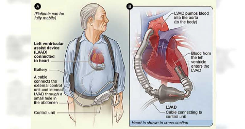 移除葉克膜改裝心室輔助器「並不代表病情好轉」，可能是有機會做心臟移植，因此才改裝輔助器延續時間。 (圖／美國國家衛生研究院)