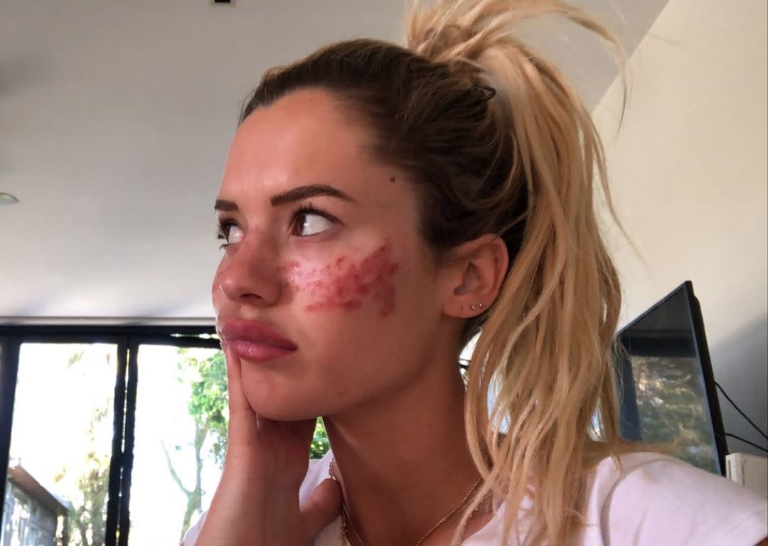 Australian reality TV star Tilly Whitfeld is warning her Instagram followers not to participate in the TikTok homemade freckles trend after it left her with permanent scars. (Photo: Instagram, Tilly Whitfield)