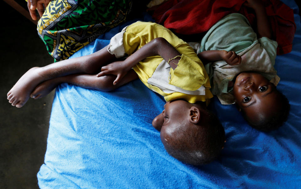 <p>Severely acute malnourished and internally displaced Congolese children wait to receive medical attention at the Tshiamala general referral hospital of Mwene Ditu in Kasai Oriental Province in the Democratic Republic of Congo, March 15, 2018. (Photo: Thomas Mukoya/Reuters) </p>