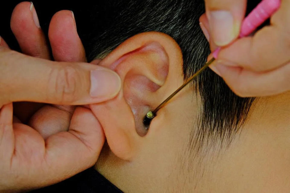<strong>一名五男子因長期挖耳朵罹患罕見的外耳道癌。 （示意圖／達志影像）</strong>