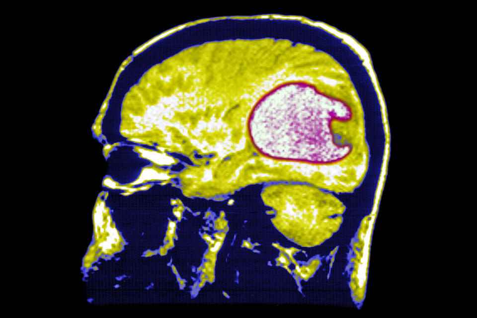 A brain scan showing a glioblastoma. (BSIP / Universal Images Group via Getty Images file)