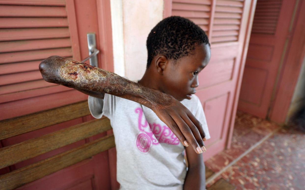 A young boy shows his arm skin damaged by Buruli ulcer in Ivory Coast - AFP