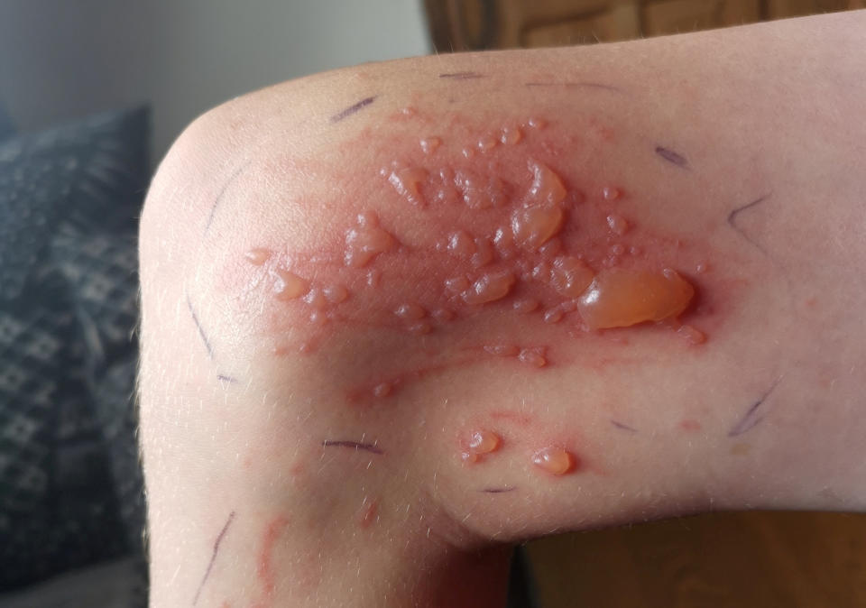 Doctors have told Jayden that he could be left with scarring from the blisters. (SWNS)