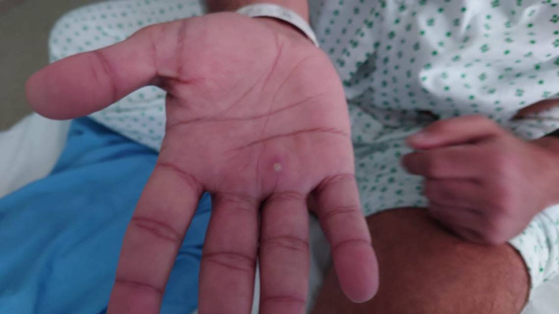 A blister is seen on Harun Tulunay’s hand while he was in the hospital for monkeypox.