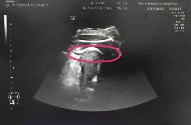 Ultrasounds showed the baby's foot poking into her mum's abdomen. Photo: Peking University Shenzen Hospital