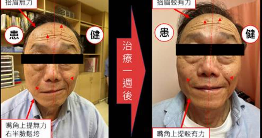 王先生經過中醫針灸治療後，抬眉、嘴角肌肉都明顯恢復力量。（圖／醫師提供）