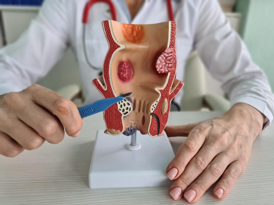 Dependiendo del tipo de hemorroides y de su gravedad, el médico podría recomendar tratamientos con medicamentos o hacer una intervención quirúrgica. (Getty Creative)