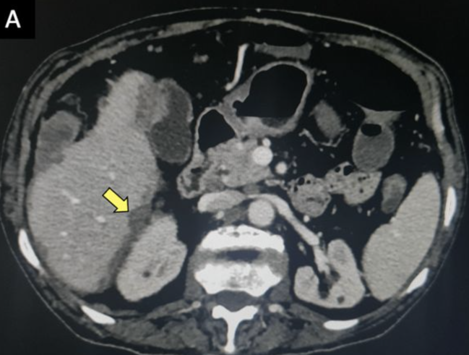 A CT scan shows the 'frosted liver' of a 53-year-old man.