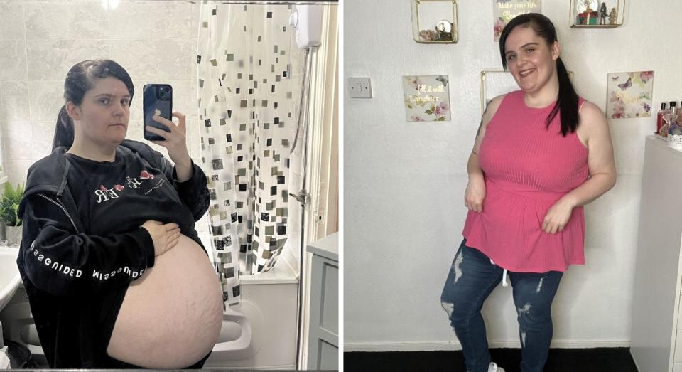 Siobhan Foster says strangers assumed she was pregnant after she developed a 40cm cyst in her stomach. (Siobhan Foster/SWNS)