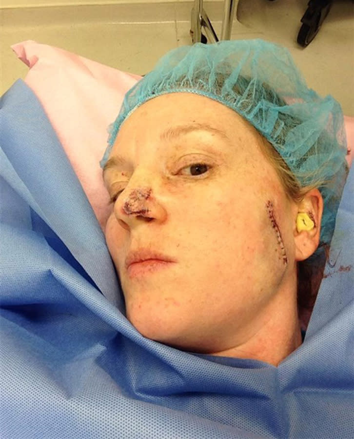 Lisa Pace after surgery to remove skin cancer