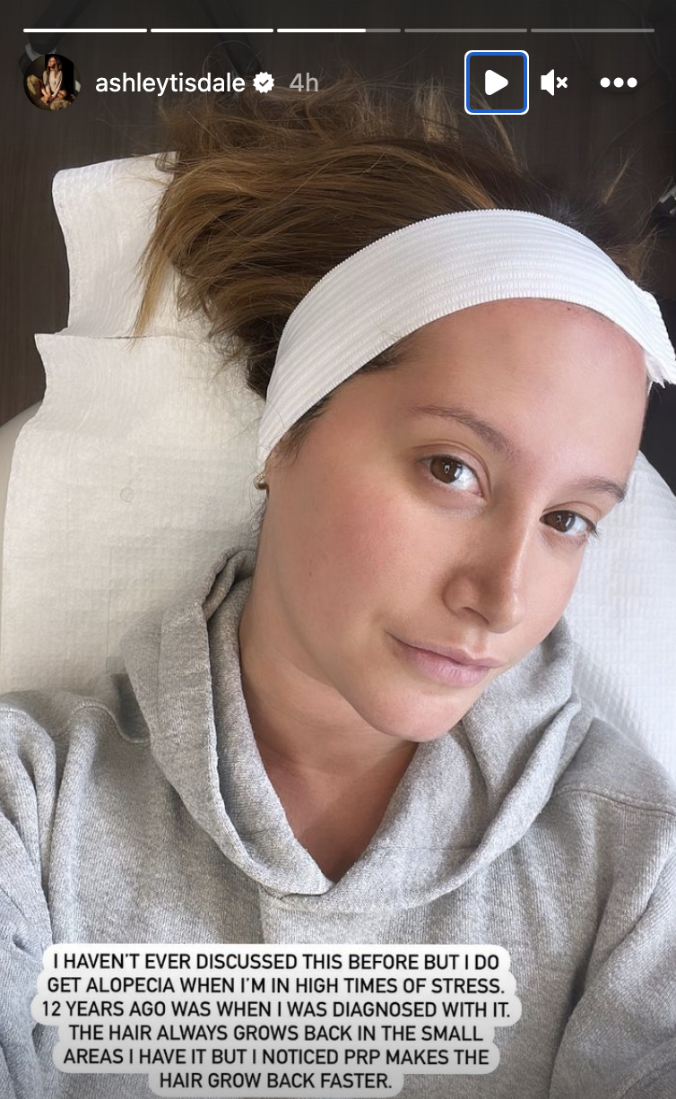 Ashley Tisdale talks about how she deals with hair loss. (Photo: Ashley Tisdale/Instagram)