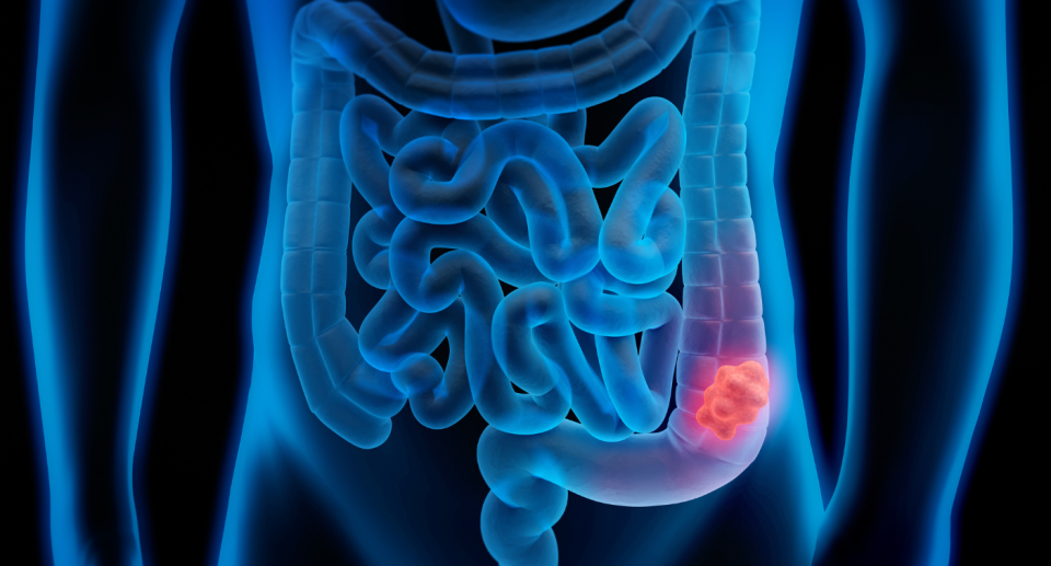 human body of in blue and black with colon tumour highlighted, colorectal cancer anatomy