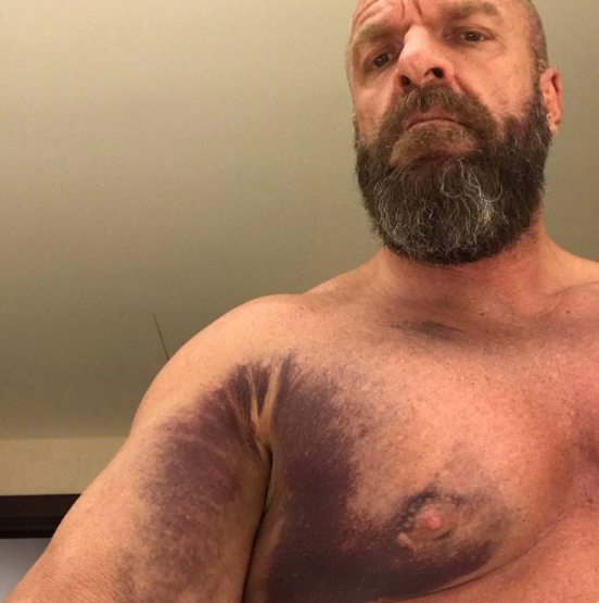 Famed wrestler Triple H kept fighting after suffering a pectoral tear during a live match last week in Saudi Arabia. Here’s what his recovery will look like. (Photo: Twitter: @TripleH)