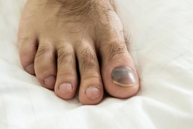 腳指甲變黑是癌上身 醫揭 4個可能原因 要提防