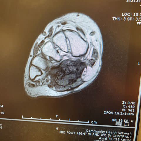 <p>Sierra Diller</p> An X-Ray of the tumor in Sierra Diller's foot
