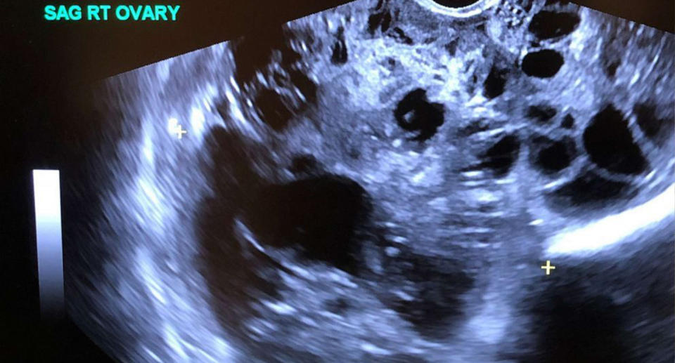 The mum's 16cm ovary on an ultrasound.