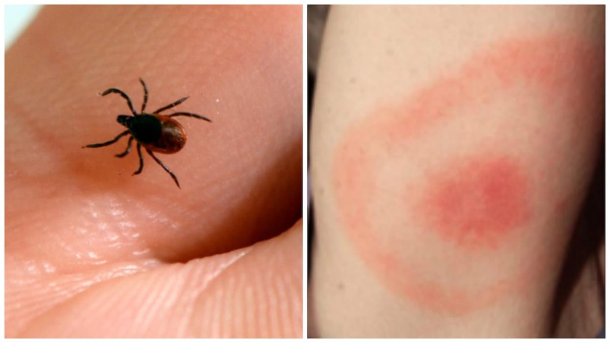 Deer ticks such as the one on the right sometimes carry bacteria that can cause Lyme disease. Symptoms include fever, chills and rashes that can resemble a bull's-eye, as seen in the photo on the right.  (CBC - image credit)