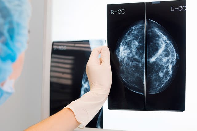 <p>Getty</p> Stock image of a mammogram scan.