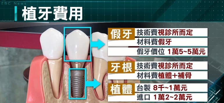 在台灣一顆人工植牙大約需要6-15萬塊，價格非常昂貴，消基會也在2016年公布了植牙的痛苦指數，民眾面對高昂植牙的痛苦指數更不低於買房。（圖／東森新聞）