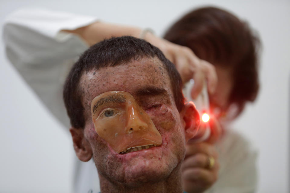 In this April 9, 2014 photo, Dr. Sulamita Chaibub assists Djalma Antonio Jardim who has a rare inherited skin disease known as xeroderma pigmentosum, or "XP" at the Hospital Geral de Goias in Goiania, Goias state, Brazil. "I was always exposed to the sun, working, planting and harvesting rice and caring for the cows," said Jardim. "As the years passed my condition got worse." (AP Photo/Eraldo Peres)