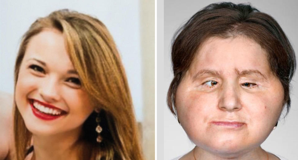 A 21-year-old woman named Katie Stubblefield (pictured left in 2013 and right in 2018) has become the youngest person in the United States to receive a face transplant after the country's first face transplant on Connie Culp in 2008