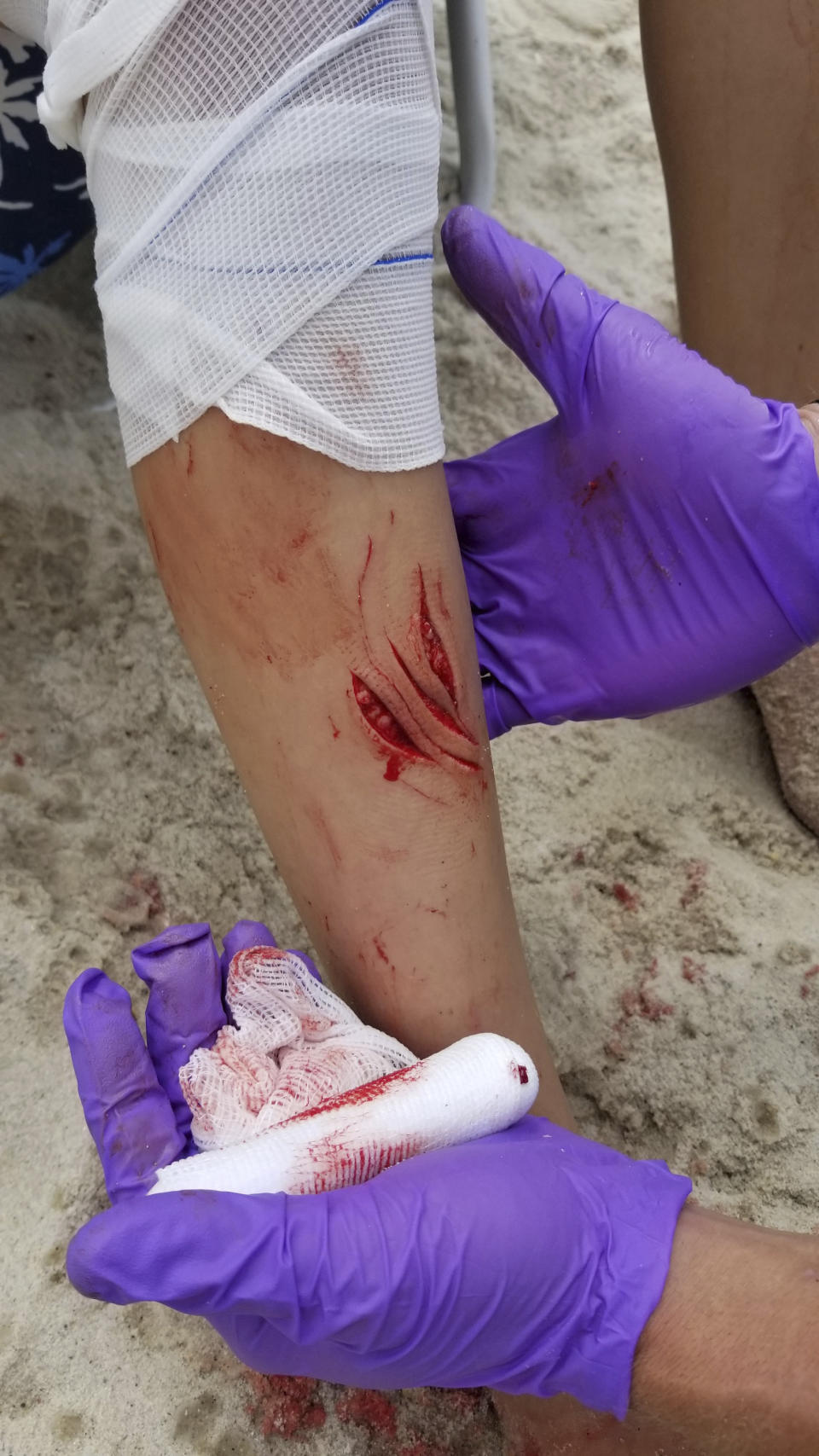 In this photo provided by Philip Pollina, a first responder treats wounds consistent with a shark attack on the leg of Pollina’s 12-year-old daughter, Lola. Source: AP