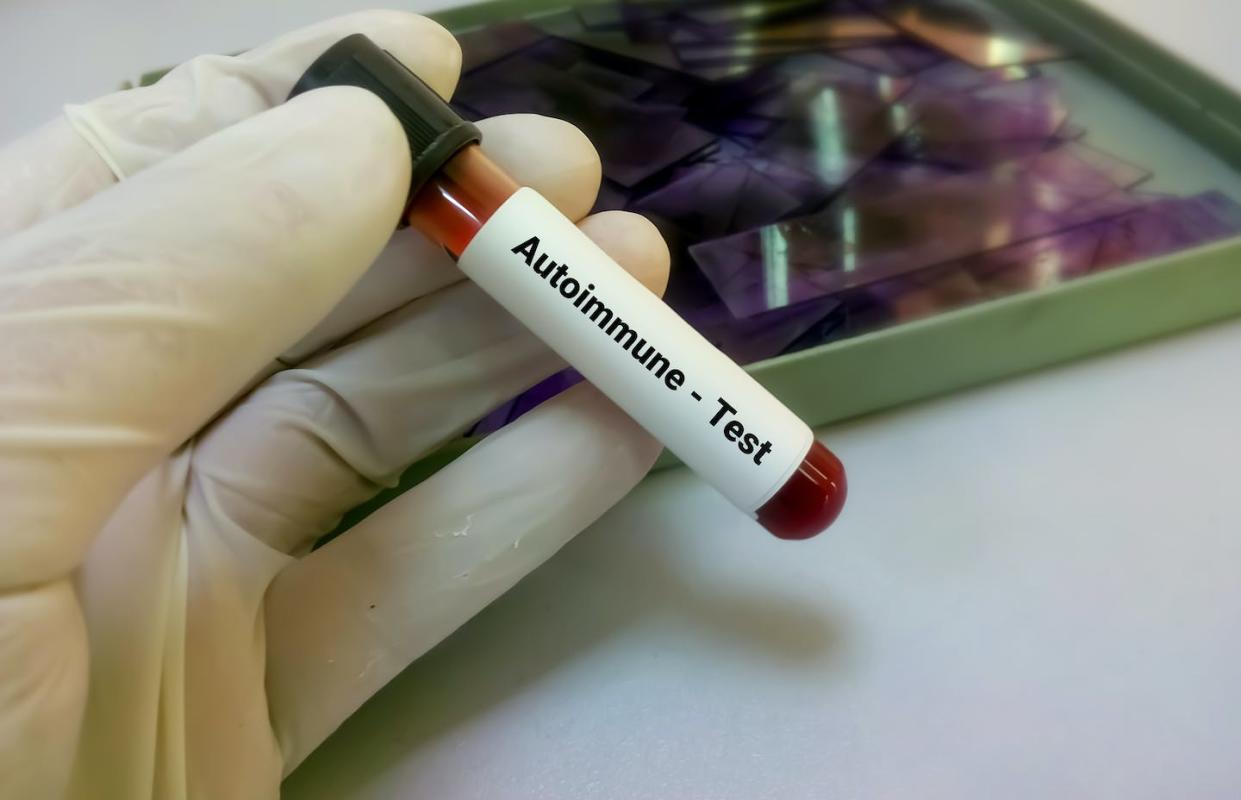 <a href="https://www.shutterstock.com/es/image-photo/blood-sample-autoimmune-disease-test-disorder-1844050663" rel="nofollow noopener" target="_blank" data-ylk="slk:Shutterstock / Saiful52;elm:context_link;itc:0;sec:content-canvas" class="link ">Shutterstock / Saiful52</a>