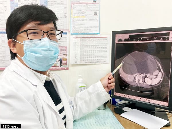 南投醫院外科廖師賢醫師依電腦斷層影像指出肝臟約二十二公分之大囊腫。(記者蔡榮宗攝)