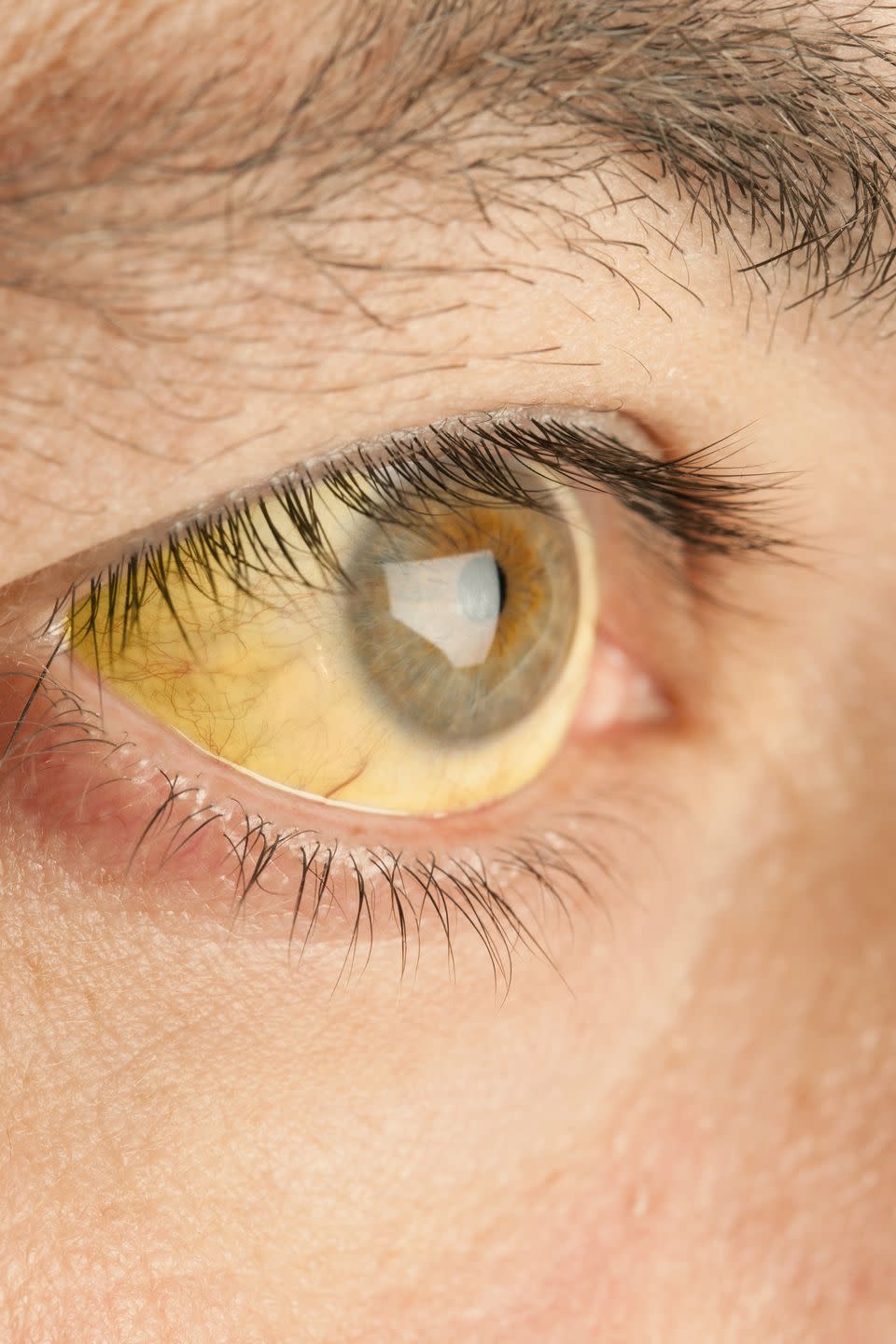 <p>If the whites of your eyes are yellowing like old paper, it should come as no surprise that this is definitely a <a href="https://www.womansday.com/health-fitness/womens-health/g2923/heart-attack-warning-signs/" rel="nofollow noopener" target="_blank" data-ylk="slk:warning sign;elm:context_link;itc:0;sec:content-canvas" class="link ">warning sign</a> something is wrong in your body. The biggest contenders for culprit? Jaundice, a condition that occurs when there's too much bilirubin — a yellow compound formed from the breakdown of red blood cells — in your blood. If your liver can't filter the cells, bilirubin builds up and can cause your eyes and skin to turn yellow. It's pretty rare in adults (sometimes babies are born with jaundice), but much of the time it's due to an infection like hepatitis, alcohol-related liver disease, or something blocking your bile ducts like gallstones or cancer.<br></p>