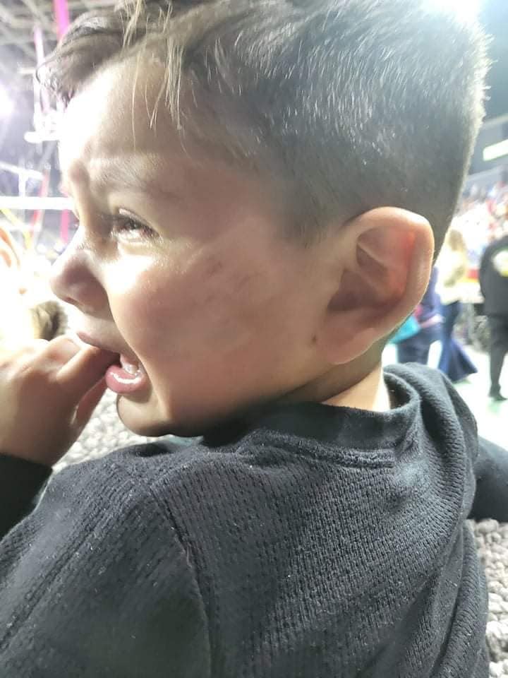 Grayson Tyring, 2, was bitten by a pony after riding the animal before a Hadi Shrine Circus performance last weekend, his mother said. The wound has since healed.