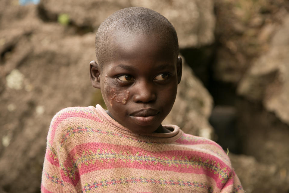 Daisy Chepsang, 10, bears the lesions caused by cutaneous leishmaniasis, which has plagued her impoverished community in a remote part of Kenya where even basic healthcare is far away. (Photo: Zoe Flood)