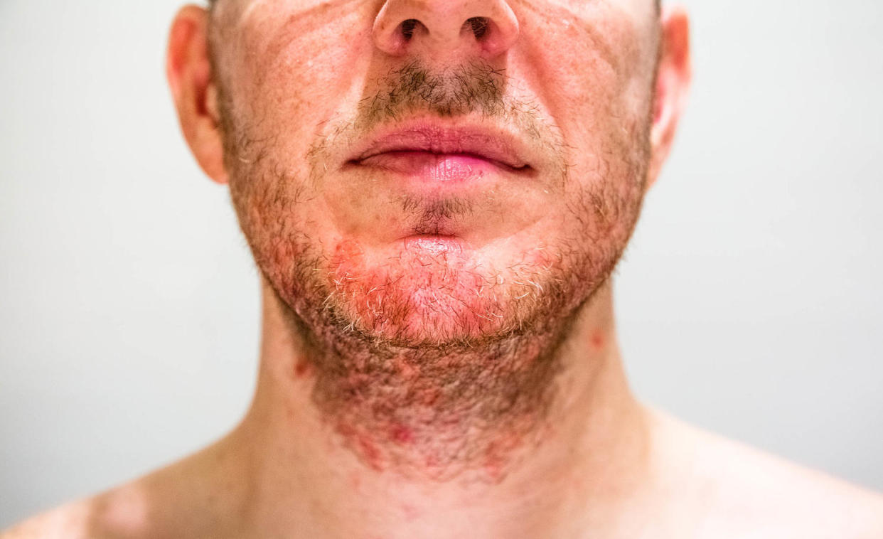Folliculitis often appears in areas where you shave. (Getty Images)