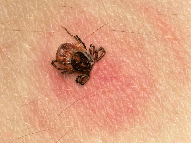 Everything You Need To Know About Tick Bites And Lyme Disease