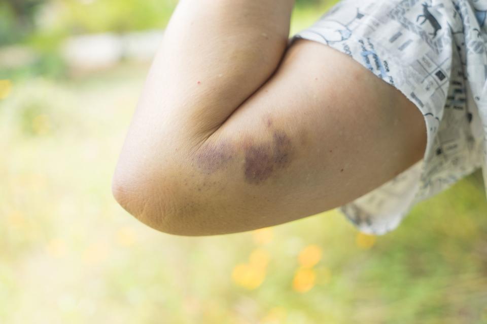 Doctors Explain the Strange Things That Can Make You Bruise So Easily