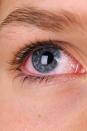 <p>Broken blood vessels may look alarming, but for the most part they're simply an indication that your eyes are working overtime. "It most likely is caused <a href="https://www.womansday.com/food-recipes/a57427/cough-cure-chocolate/" rel="nofollow noopener" target="_blank" data-ylk="slk:by coughing;elm:context_link;itc:0;sec:content-canvas" class="link ">by coughing</a> or straining," Dr. Herz explains. "Even though it looks blood-red and terrible, it is harmless and not indicative of any eye disease."<br></p>