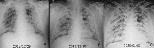 Pulmones del paciente de 44 años que falleció por el coronavirus. En un intervalo de 4 días hubo una extensión y densidad rápida de las opacidades pulmonares, que culminaron en una consolidación pulmonar bilateral predominante (RSNA)