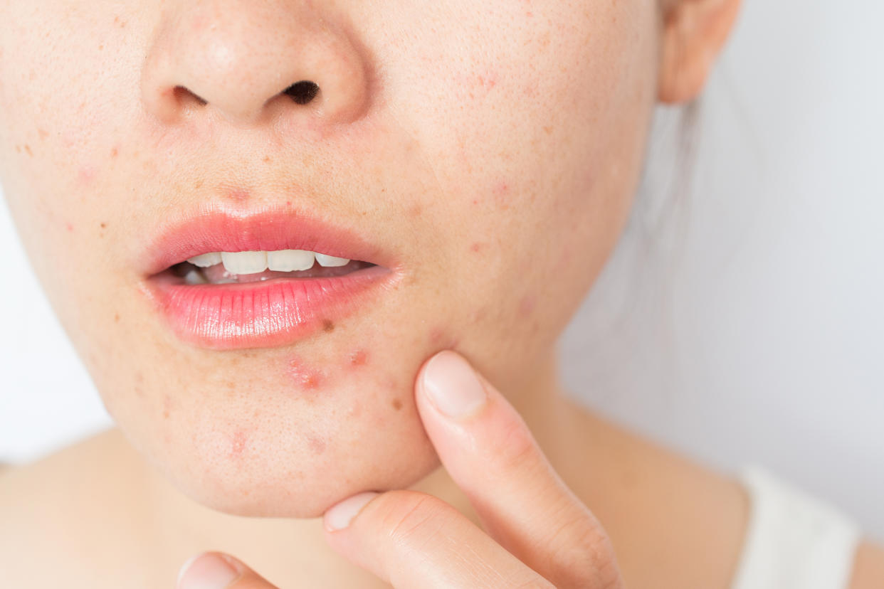 Skin conditions and photos of acne on a young white Caucasian woman (Boy_Anupong / Getty Images stock)
